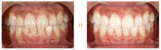 ホワイトニングで歯を白く 審美歯科矯正の青山一丁目アオイチデンタルクリニック