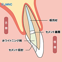 ウォーキングブリーチ