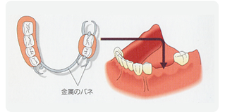 部分入れ歯