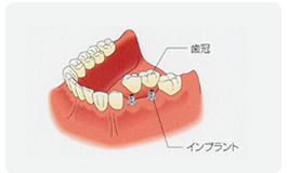 インプラント