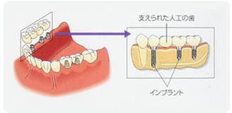 インプラント