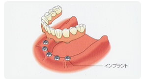 インプラント