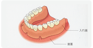 総入れ歯