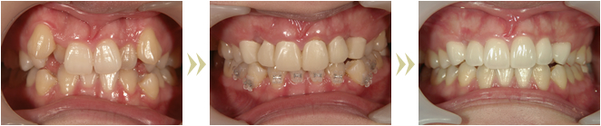 セラミック治療 ＋ 部分矯正